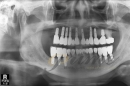 다수 치아의 임플란트 치료