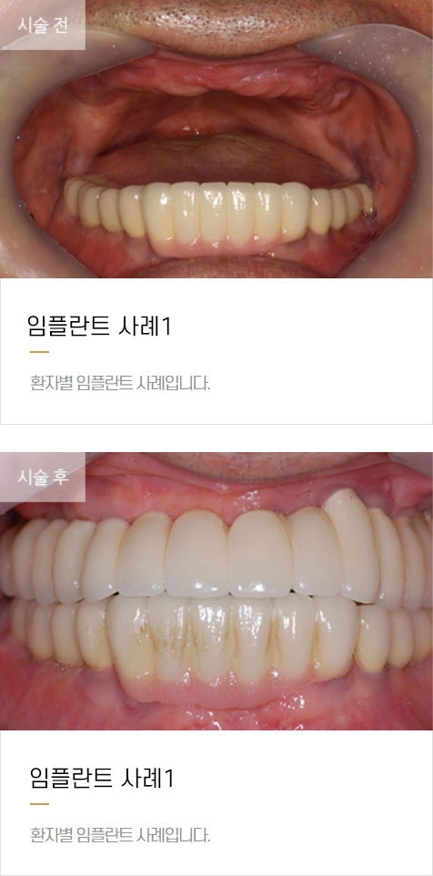 임플란트 사례