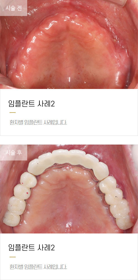 임플란트 사례