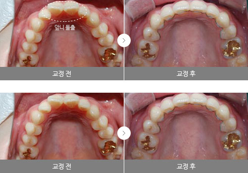 앞니부분교정