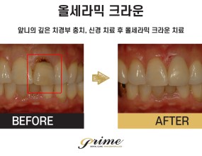 치료 전후